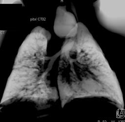 Esophageal Atresia - CTisus CT Scan