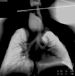 Esophageal Atresia Compresses the Trachea - CTisus CT Scan