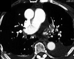 Pulmonary Embolism - CTisus CT Scan