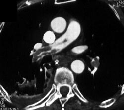 Pulmonary Embolism - CTisus CT Scan