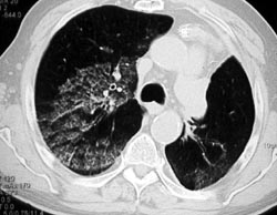 Pulmonary Hemorrhage - CTisus CT Scan