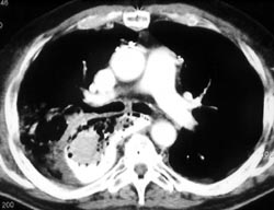 Leak From Perforated Esophagus - CTisus CT Scan