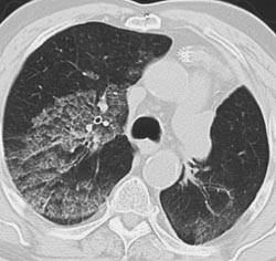 Pulmonary Hemorrhage - CTisus CT Scan