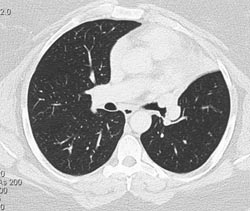 Carcinoid in Left Upper Lobe Bronchus - CTisus CT Scan