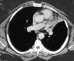 Carcinoid - CTisus CT Scan