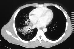 Aspiration - CTisus CT Scan