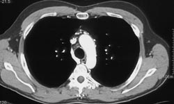 SVC Occlusion - CTisus CT Scan