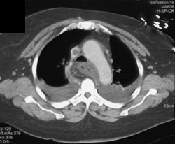 Clot in SVC and Right Atrium - CTisus CT Scan