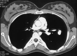 Pulmonary Arteriovenous Malformation (PAVM) - CTisus CT Scan