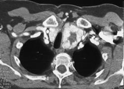 Thyroid Goiter - CTisus CT Scan