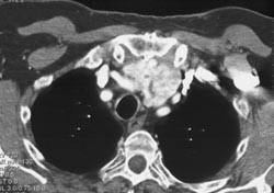 Substernal Thyroid - CTisus CT Scan