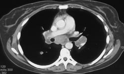 Right Supraclavicular Adenopathy and Right and Left Hilar Adenopathy - CTisus CT Scan