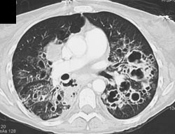 Bronchiectasis - CTisus CT Scan