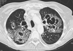 Bronchiectasis - CTisus CT Scan