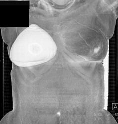 Breast Prosthesis - CTisus CT Scan