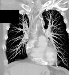 Mediastinal Collaterals - CTisus CT Scan