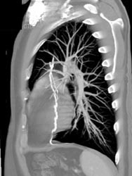 Prominent Superior Intercostal Vein - CTisus CT Scan