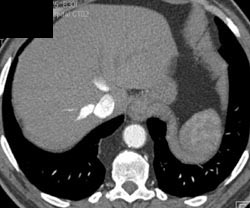 Increased Fat in the Posterior Mediastinum - CTisus CT Scan