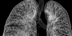 Tracheal Stenosis - CTisus CT Scan