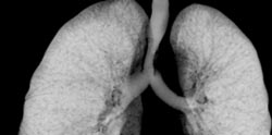 Tracheal Stenosis - CTisus CT Scan