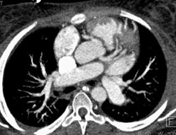 Coronary Angiogram - CTisus CT Scan