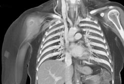 Clot in Innominate Artery - CTisus CT Scan