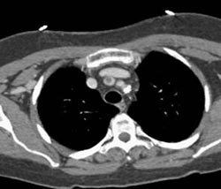 Clot in Right Innominate Artery - Chest Case Studies - CTisus CT Scanning