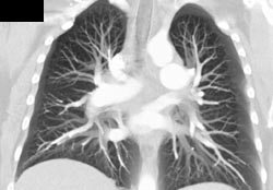 Normal Superior Vena Cava (SVC) - CTisus CT Scan