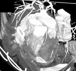 Coronary Artery Disease - CTisus CT Scan