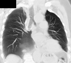 Stent in Right Mainstem Bronchus - CTisus CT Scan