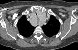 Substernal Thyroid - CTisus CT Scan