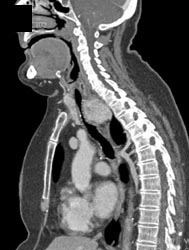 Thyroid Extends Into the Posterior Mediastinum - CTisus CT Scan