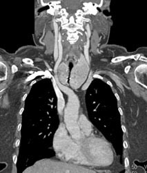 Substernal Thyroid - CTisus CT Scan