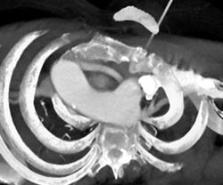 Right Aortic Arch With Aberrant Subclavian Artery - CTisus CT Scan