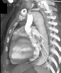 Ectatic Aorta - CTisus CT Scan