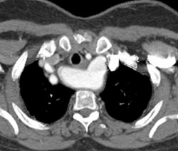 Right Arch With Aberrant Left Subclavian Artery - CTisus CT Scan