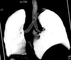 Stent in Airway - CTisus CT Scan