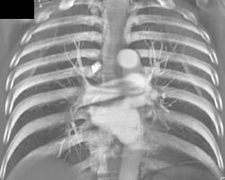 Pulmonary Embolism - CTisus CT Scan