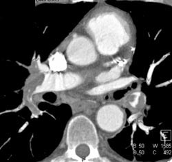 Pulmonary Embolism - CTisus CT Scan