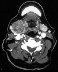 Patent Jugular Vein - CTisus CT Scan