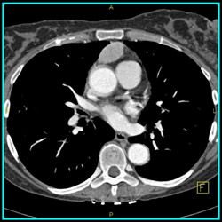 Thymoma - CTisus CT Scan