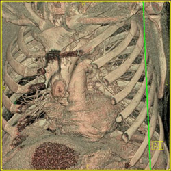 Post Coronary Artery Bypass Graft (CABG) - CTisus CT Scan