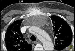 Aortic Dissection - CTisus CT Scan