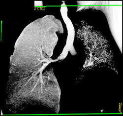 Stenosis to Transplanted Lung - CTisus CT Scan