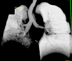 Stenosis Left Mainstem Bronchus - CTisus CT Scan