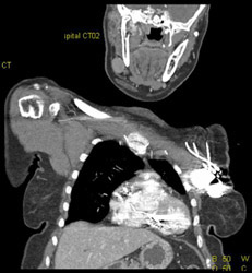 Lipoma Left Axilla - CTisus CT Scan