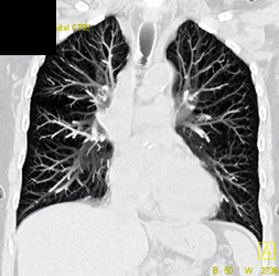 Calcifications in Tracheal Cartilage - CTisus CT Scan