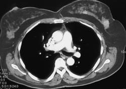 Mass in Left Breast - CTisus CT Scan