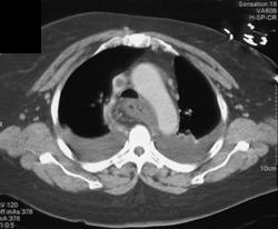 SVC Clot Into Right Atrium - CTisus CT Scan