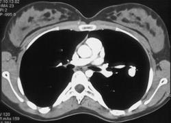 Pulmonary Arteriovenous Malformation (PAVM) - CTisus CT Scan